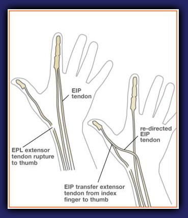 Tendon Transfer Diagram