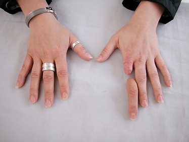 Amputation Hand Finger-Hand Surgery-Wrist Surgery-Elbow Surgery