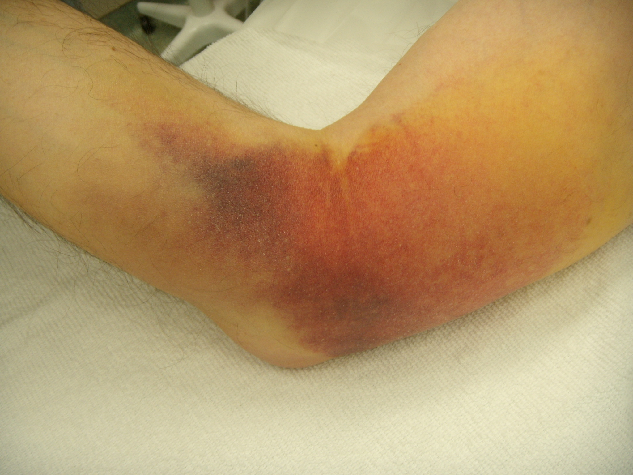 Triceps Tear Clinical Picture
