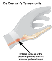 DeQuervains Diagram