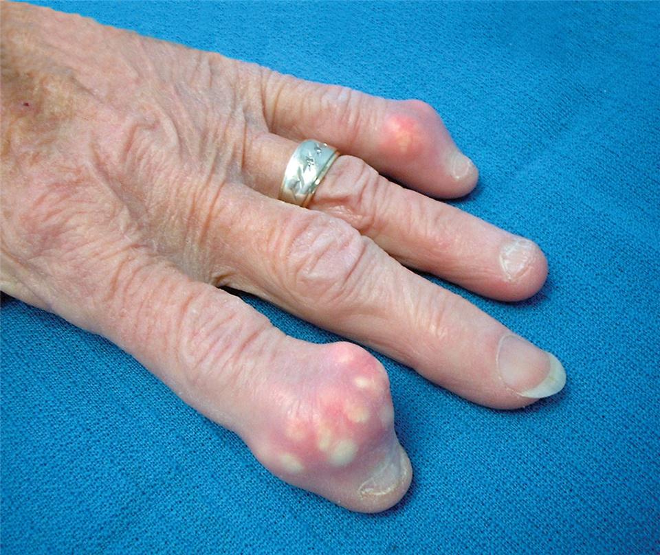 Hamate Hook Fracture