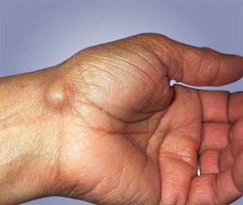 Volar Ganglion Cyst