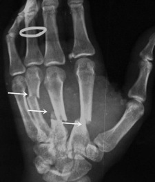 Metacarpal Fracture